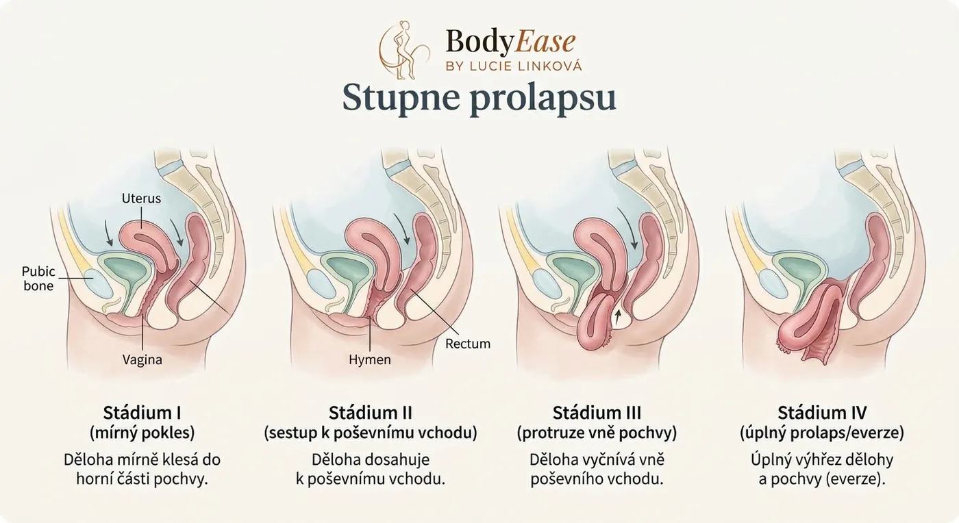 Čtyři stadia prolapsu dělohy: od mírného poklesu po úplný výhřez