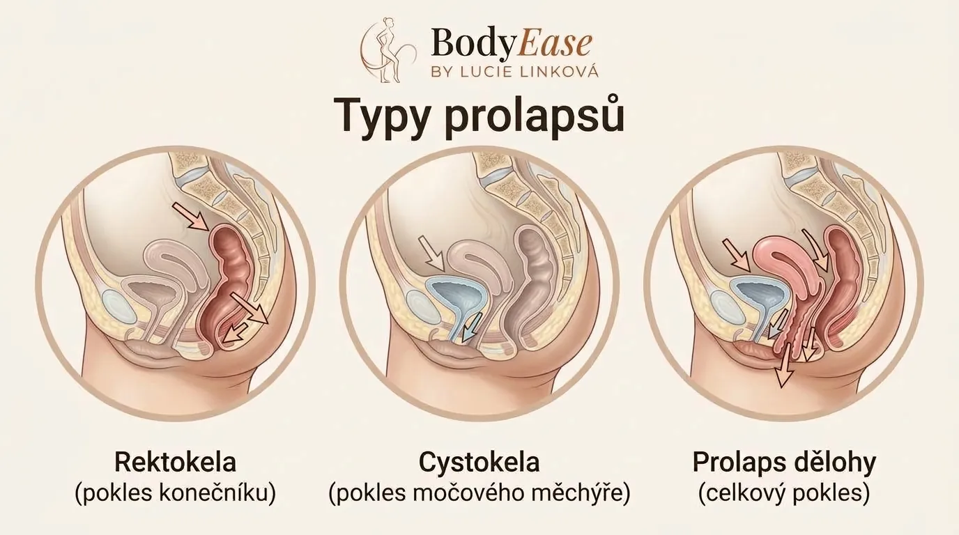 Typy prolapsu: rektokéla, cystokéla a prolaps dělohy