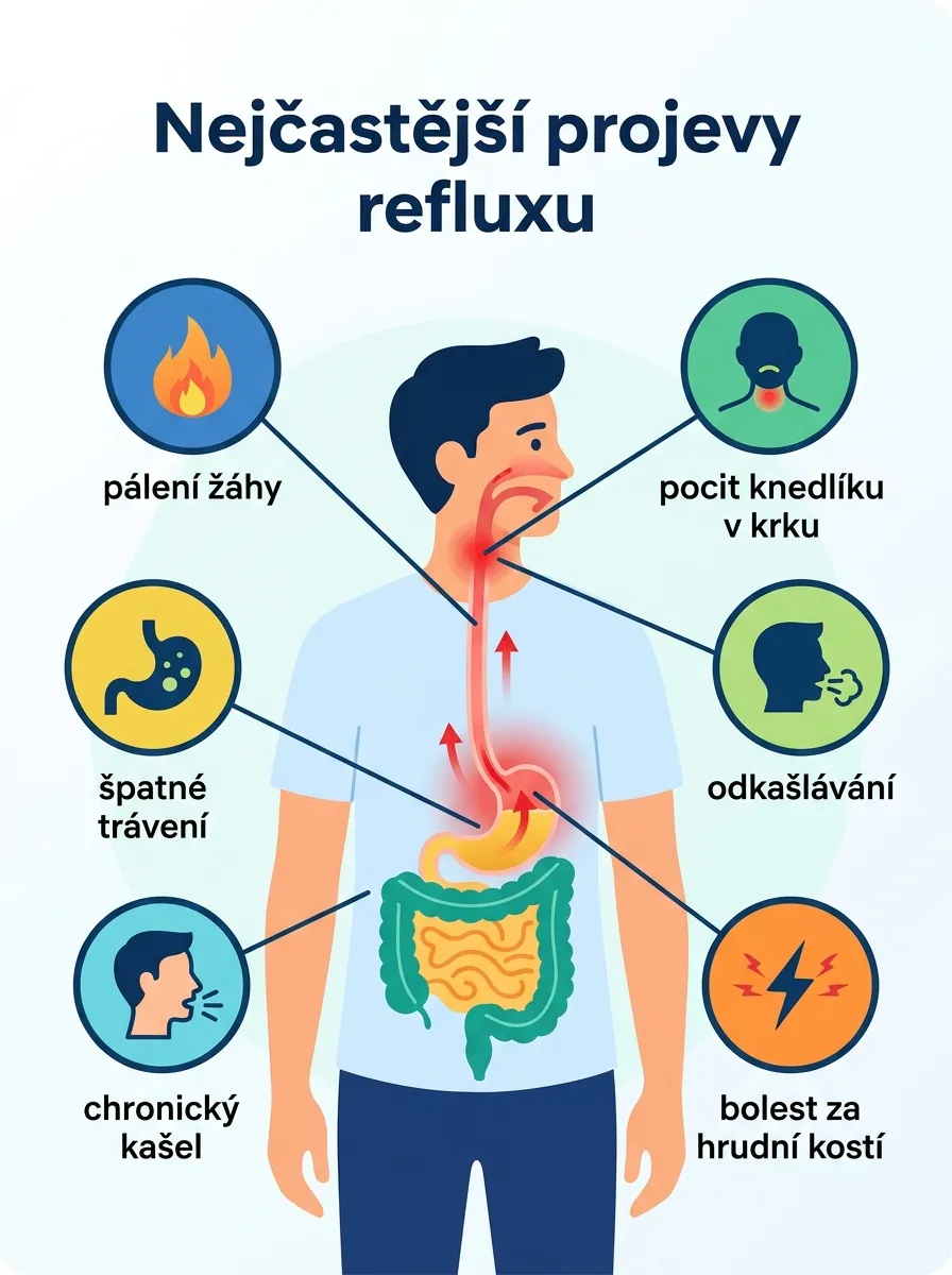 Infografika: nejčastější projevy refluxu — pálení žáhy, knedlík v krku, špatné trávení, odkašlávání, chronický kašel, bolest za hrudní kostí